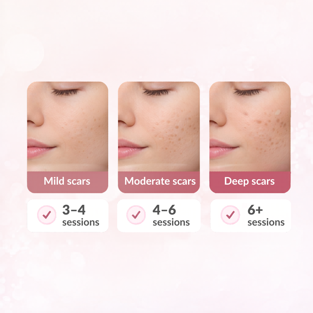 microneedling for scars